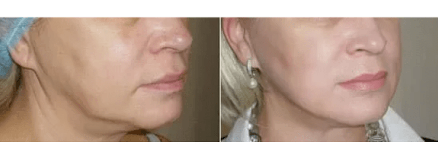 felépülés a bőrfiatalítás után