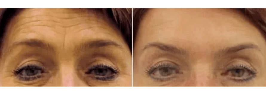 frakcionált fiatalítást szolgáló eszközök