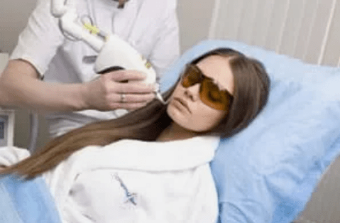 frakcionált lézeres fiatalítás